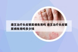 康王治疗头皮银屑病有用吗 康王治疗头皮银屑病有用吗多少钱