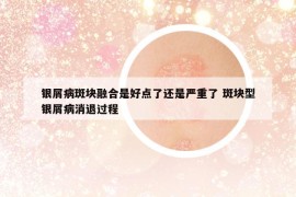 银屑病斑块融合是好点了还是严重了 斑块型银屑病消退过程