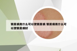 银屑病用什么可以使银屑病 银屑病用什么可以使银屑病好