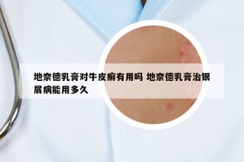 地奈德乳膏对牛皮癣有用吗 地奈德乳膏治银屑病能用多久