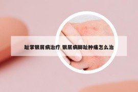 趾掌银屑病治疗 银屑病脚趾肿痛怎么治