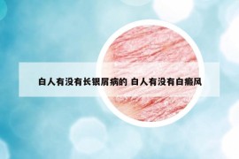 白人有没有长银屑病的 白人有没有白癜风