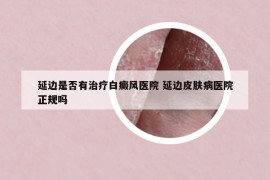 延边是否有治疗白癜风医院 延边皮肤病医院正规吗
