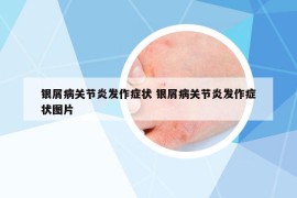 银屑病关节炎发作症状 银屑病关节炎发作症状图片