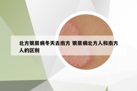 北方银屑病冬天去南方 银屑病北方人和南方人的区别