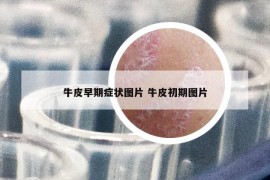牛皮早期症状图片 牛皮初期图片