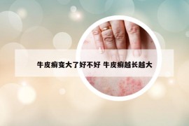 牛皮癣变大了好不好 牛皮癣越长越大