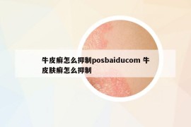 牛皮癣怎么抑制posbaiducom 牛皮肤癣怎么抑制