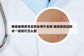 脚底板痒抓完皮肤白像牛皮癣 脚底痒抓后脱皮一层层烂怎么整