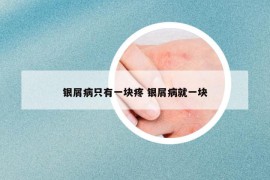 银屑病只有一块疼 银屑病就一块