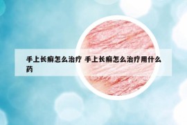 手上长癣怎么治疗 手上长癣怎么治疗用什么药