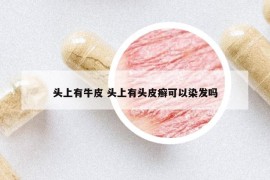 头上有牛皮 头上有头皮癣可以染发吗