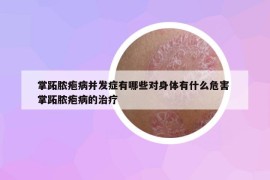 掌跖脓疱病并发症有哪些对身体有什么危害 掌跖脓疱病的治疗