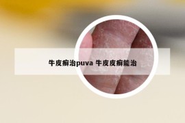 牛皮癣治puva 牛皮皮癣能治