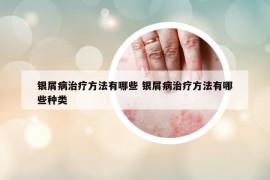 银屑病治疗方法有哪些 银屑病治疗方法有哪些种类