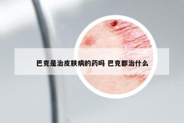 巴克是治皮肤病的药吗 巴克都治什么