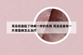 耳朵后面起了块癣一样的东西 耳朵后面有一片像是癣怎么治疗