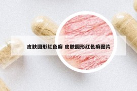 皮肤圆形红色癣 皮肤圆形红色癣图片