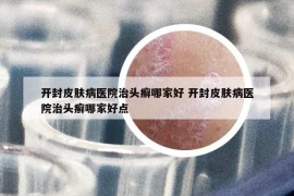 开封皮肤病医院治头癣哪家好 开封皮肤病医院治头癣哪家好点