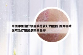 中国哪里治疗银屑病比较好的医院 国内哪家医院治疗银屑病效果最好
