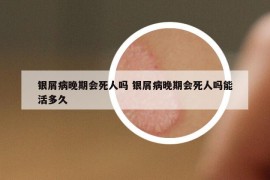 银屑病晚期会死人吗 银屑病晚期会死人吗能活多久