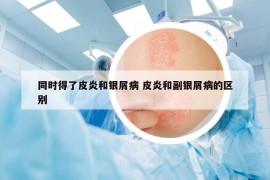同时得了皮炎和银屑病 皮炎和副银屑病的区别