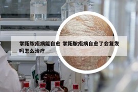 掌跖脓疱病能自愈 掌跖脓疱病自愈了会复发吗怎么治疗