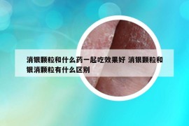 消银颗粒和什么药一起吃效果好 消银颗粒和银消颗粒有什么区别