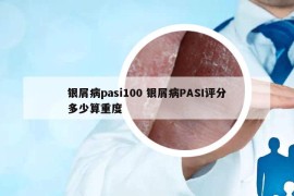银屑病pasi100 银屑病PASI评分多少算重度