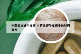 中药能治好牛皮癣 中药治好牛皮癣多长时间复发