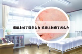 眼睛上长了藓怎么办 眼睛上长癣了怎么办