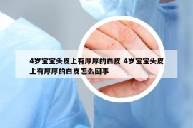 4岁宝宝头皮上有厚厚的白皮 4岁宝宝头皮上有厚厚的白皮怎么回事