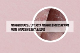 银屑病修美乐几针见效 银屑病患者使用生物制剂 修美乐的治疗全过程
