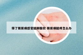 得了银屑病感觉腿脚酸软 银屑病腿疼怎么办