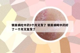银屑病吃中药9个月又发了 银屑病喝中药好了一个月又复发了