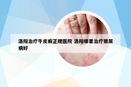 洛阳治疗牛皮癣正规医院 洛阳哪里治疗银屑病好