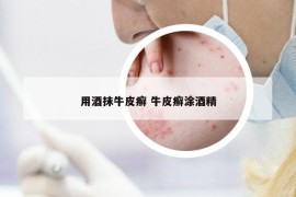 用酒抹牛皮癣 牛皮癣涂酒精