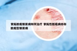 掌跖脓疱银屑病如何治疗 掌跖性脓疱病亦称脓疱型银屑病