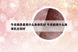 牛皮癣患者用什么身体乳好 牛皮癣用什么身体乳比较好