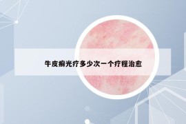 牛皮癣光疗多少次一个疗程治愈
