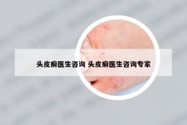 头皮癣医生咨询 头皮癣医生咨询专家