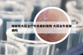 辣椒和大蒜治疗牛皮癣的视频 大蒜治牛皮鲜病吗