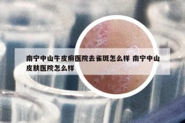 南宁中山牛皮癣医院去雀斑怎么样 南宁中山皮肤医院怎么样