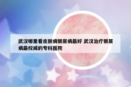武汉哪里看皮肤病银屑病最好 武汉治疗银屑病最权威的专科医院