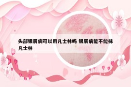 头部银屑病可以用凡士林吗 银屑病能不能抹凡士林