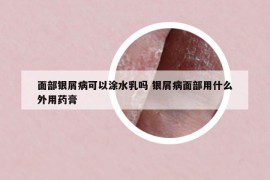 面部银屑病可以涂水乳吗 银屑病面部用什么外用药膏