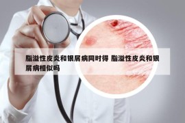 脂溢性皮炎和银屑病同时得 脂溢性皮炎和银屑病相似吗