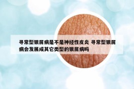 寻常型银屑病是不是神经性皮炎 寻常型银屑病会发展成其它类型的银屑病吗