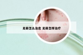 足藓怎么治愈 足藓怎样治疗