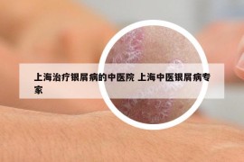 上海治疗银屑病的中医院 上海中医银屑病专家